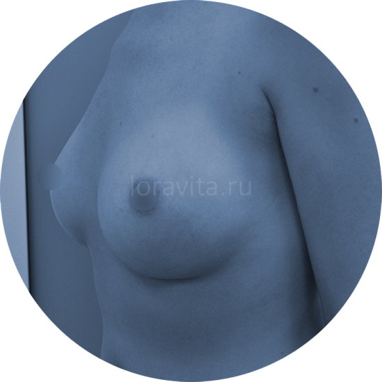 Результат увеличения груди №15