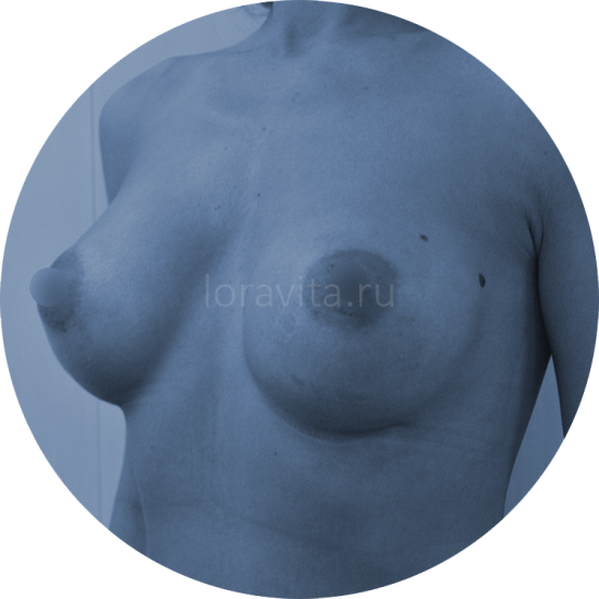 Результат увеличения груди №18