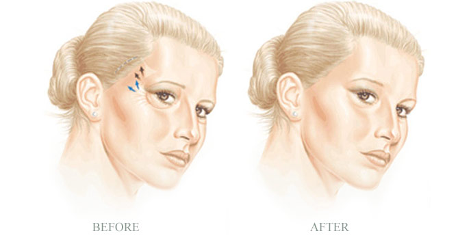 for-page-vis-lift-1.jpg for-page-vis-lift-1.jpg